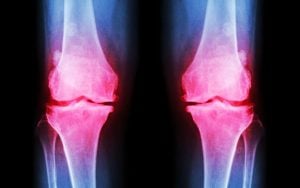 Osteoartritis: Optimističke prognoze za nove tretmane lečenja