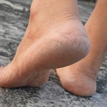 Ova namirnica spasiće vas ISPUCALIH PETA - Rešava problem na PRIRODAN NAČIN, bez mnogo truda i vremena