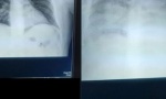 Prijave protiv kragujevačkog hirurga zbog objavljivanja snimaka pluća preminulog pacijenta