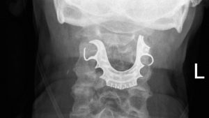 Proteza nađena u grlu muškarca nakon operacije