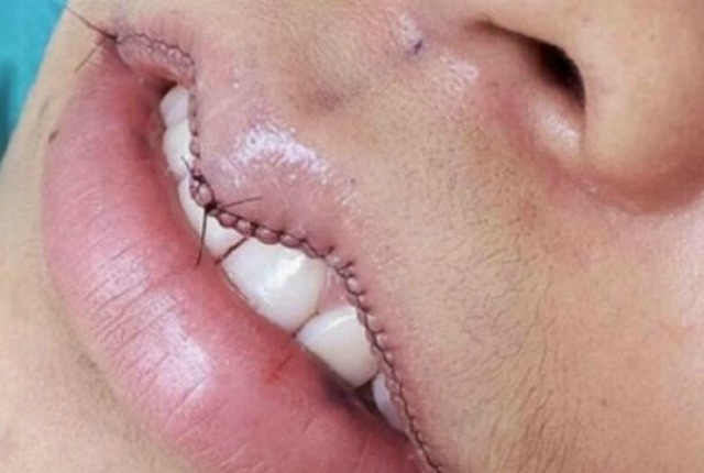 Pumpanju usana je došao kraj – ova procedura je hit u svetu!