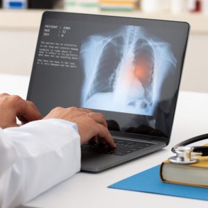 Rak pluća – jedan od najčešćih oblika karcinoma u našoj zemlji
