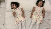 Sijamske bliznakinje i operacija: Trogodišnjakinje razdvojene teškim zahvatom uskoro će prohodati