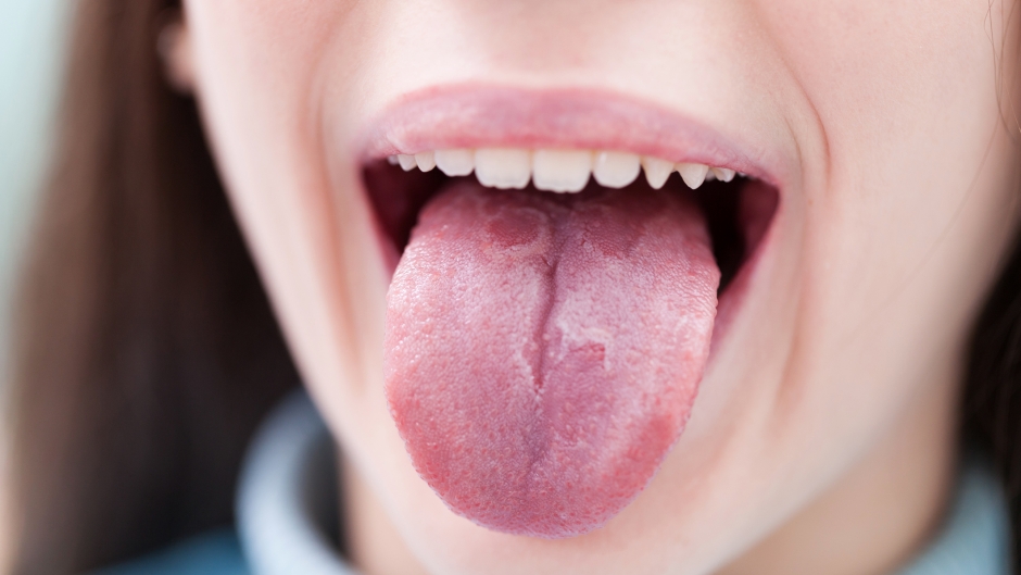 Šta da radite kad opečete jezik