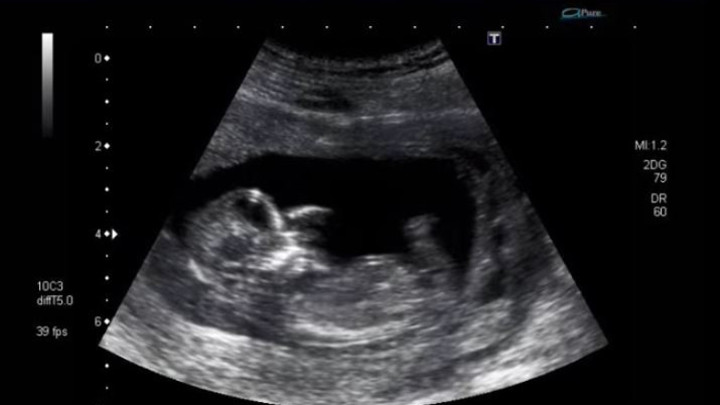 Sve trudnice bi trebalo da imaju ultrazvuk u 36. nedelji trudnoće jer može da otkrije ovu anomaliju kod bebe i spreči hitan carski rez