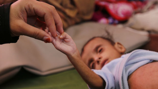 U Jemenu umrlo od gladi 85.000 dece 