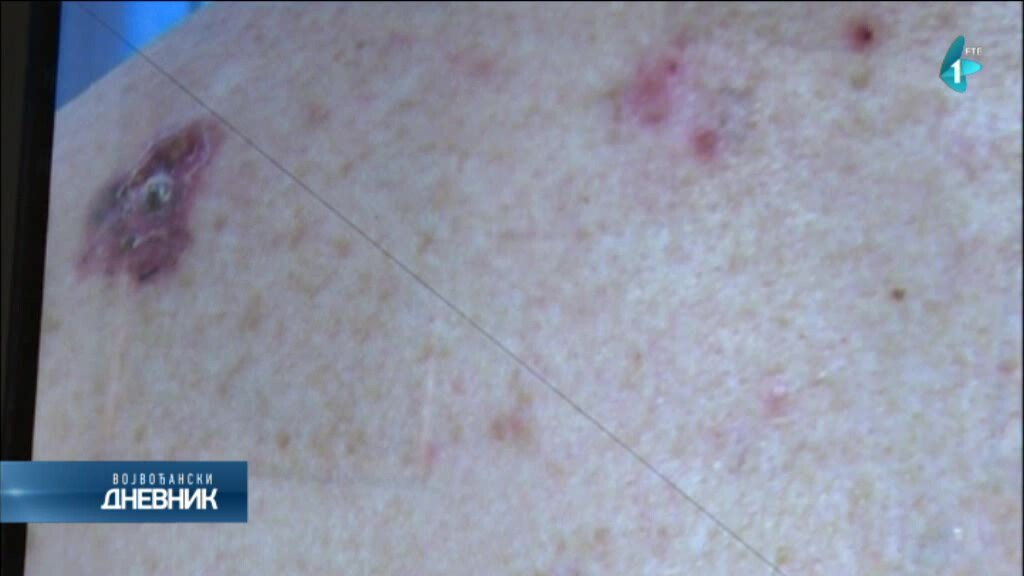 U Srbiji sve veći broj obolelih od melanoma