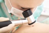 U Srbiji sve više obolelih od melanoma