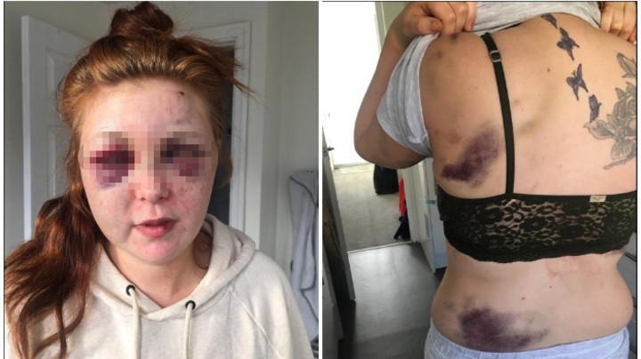 UZNEMIRUJUĆE! Majku dvoje dece momak UNAKAZIO OD BATINA! Ona objavila fotografije rana, podliva i hematoma – Prizor je JEZIV! (FOTO)