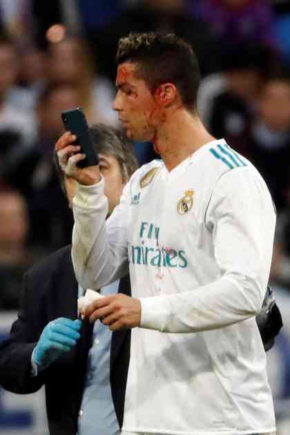 (UZNEMIRUJUĆI VIDEO) KRV LILA SA KRISTIJANOVE GLAVE: Pogledajte Ronaldovo unakaženo lice posle meča sa Deportivom
