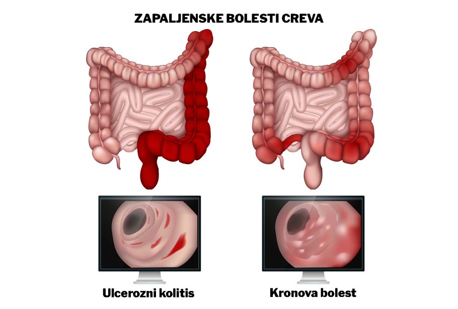 Ulcerozni kolitis se i u Srbiji može lečiti biološkom terapijom, dr Tamara Milovanović je detaljno opisuje