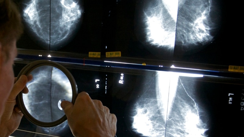 Umjetna inteligencija daje nadu u otkrivanju raka dojke