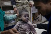 Upozoravaju: Deca umiru zbog neuhranjenosti