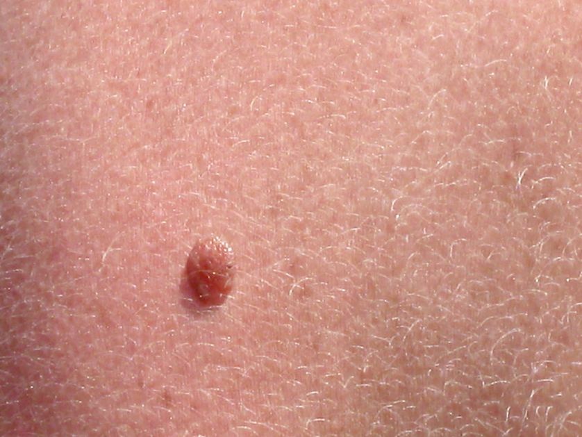 Važna edukacija o melanomu, epidemija usporila preglede