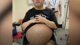 Zdravlje: Bubrezi teški 35 kilograma uklonjeni operacijo