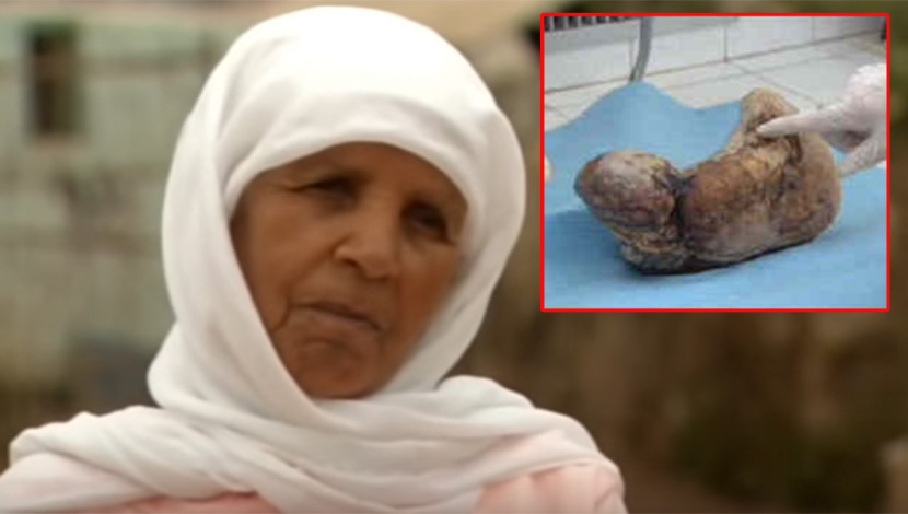 Žena bila trudna 46 godina, rodila kameno dete! (VIDEO)
