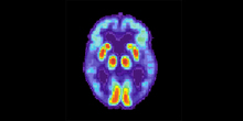 Znaci Parkinsonove i Alchajmerove bolesti vidljivi na slikama